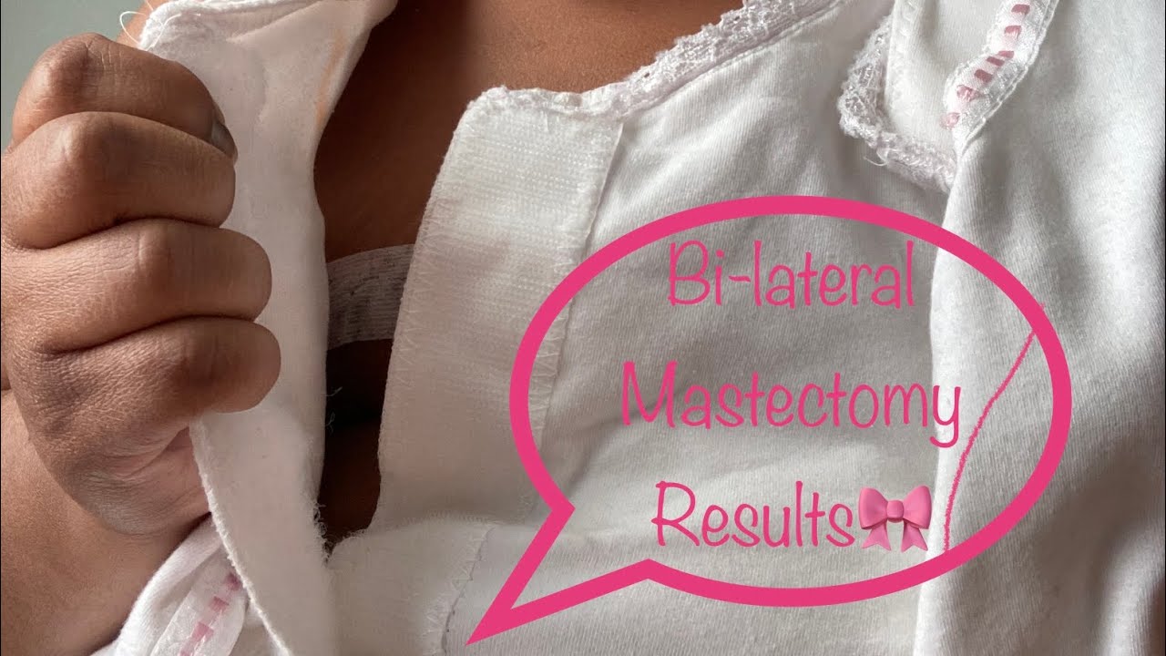 *Bilateral Simple Mastectomy Results Stage 3 Breast Cancer Patient 