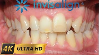 INVISALIGN treatment for 10 MONTHS! 4k time-lapse.