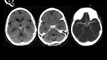 Brain imaging quiz cases 4   Prof  Mamdouh Mahfouz HD