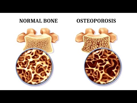 12 Foods That Fight Osteoporosis And Promote Strong Bones