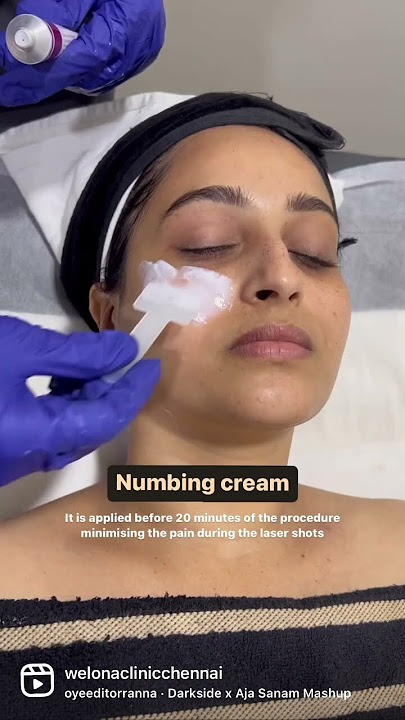 FRECKLES REMOVAL