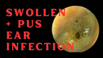 SWOLLEN & PUS FILLED EAR CANAL DUE TO INFECTION!!! (4K 60FPS)