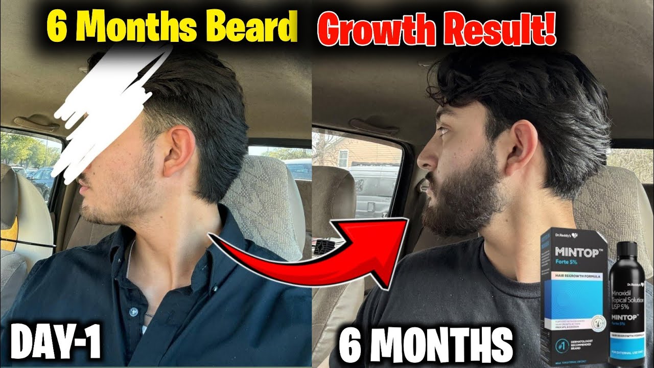 My 6 Month Beard Growth Journey | Real Results + Tips | Minoxidil Beard ...