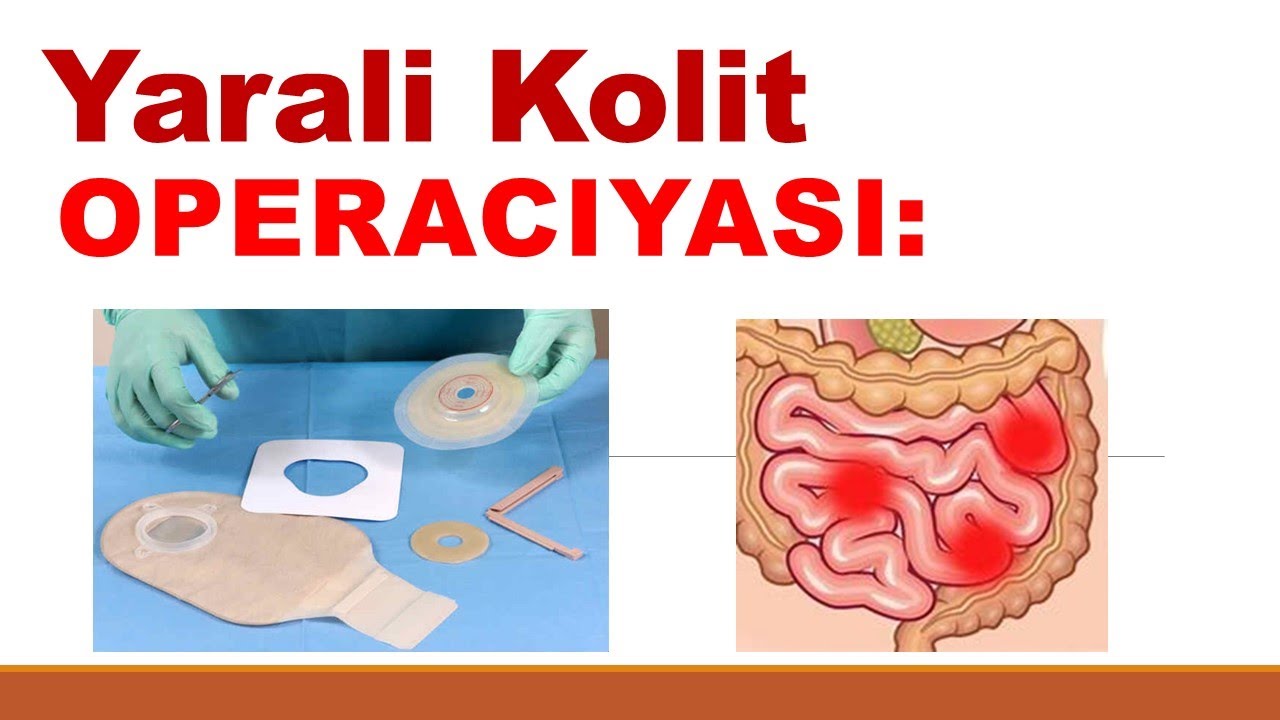 yarali kolit operaciyasi asoratlari