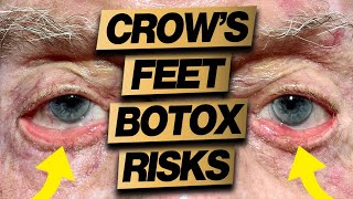 Botox Gone Wrong Crows Feet Eye & Lip Risks You Need To Know