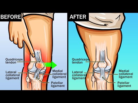 Wideo: 3 proste sposoby na rozciągnięcie skręconego kolana