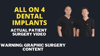 All on 4 Dental Implant Patient Surgery Video. How We Plan and Perform the Surgery by North Texas Dental Surgery 2,262 views 7 months ago 37 minutes