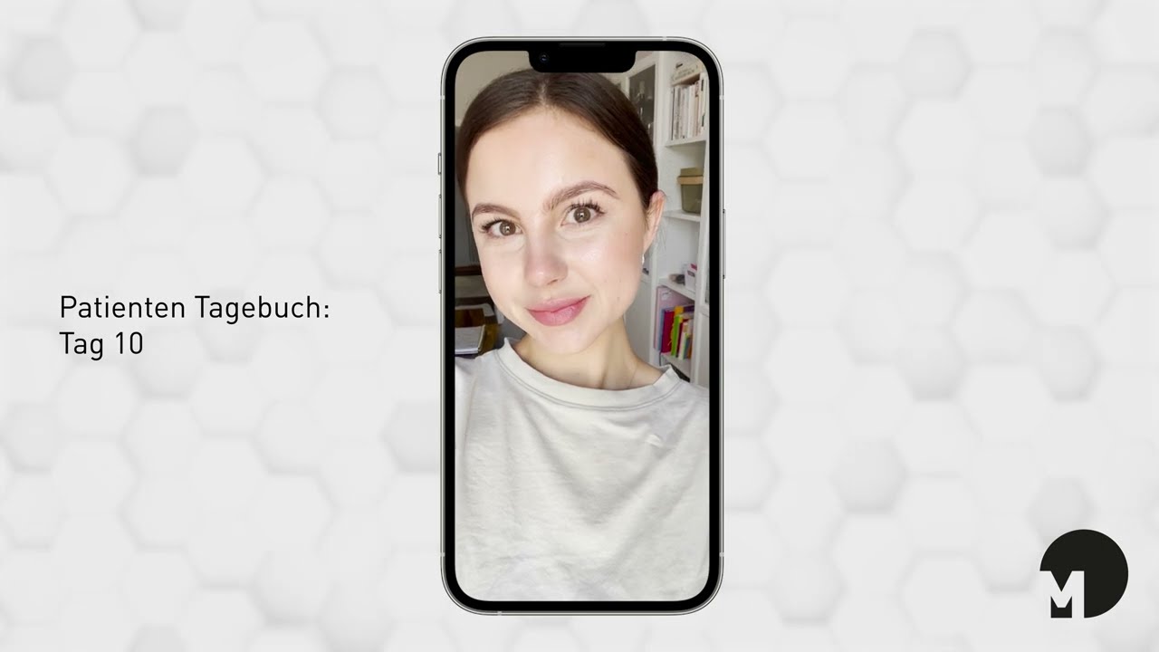 Patiententagebuch Lippenunterspritzung 0,5ml  & Korrektur der Marionettenfalten