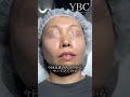 鼻の穴が気になって仕方がない40代女性の鼻整形