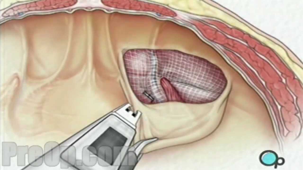 How does the laproscopic surgery repair a hernia?