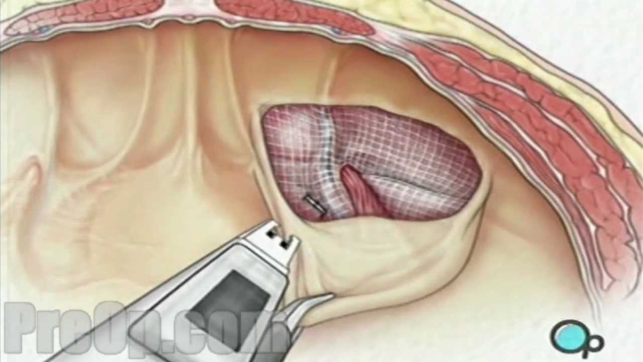 Hernia Repair Inguinal Laparoscopic PreOp Patient Education Medical 