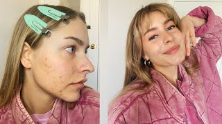 everyday makeup look ft. my acne + Q&A