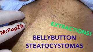 Steatocystomas and vellus hair cysts on the abdomen, chest, and arms!She has over 1,000! Extractions