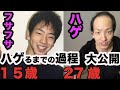 【若ハゲ】髪がフサフサ→ハゲ までの過程 写真まとめてみた