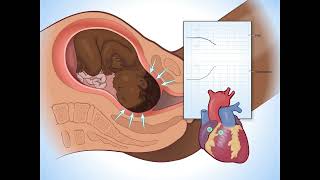 Early Decelerations - Fundamentals of Fetal Health Surveillance