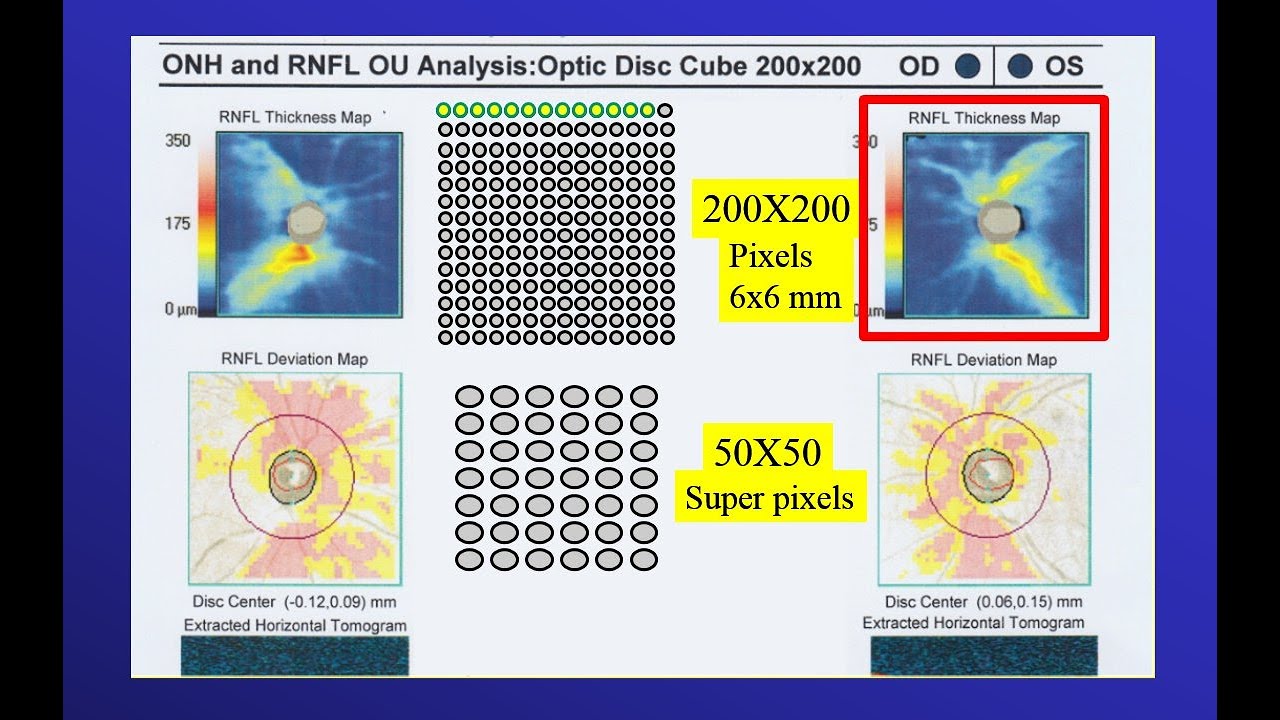 2021 OCT in Glaucoma (2) Comparing OCT machines - YouTube