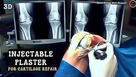 Injectable Plasters For Cartilage Repair | Animated Video