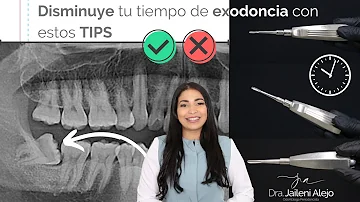 ¿Son más fáciles de extraer los dientes superiores o los inferiores?