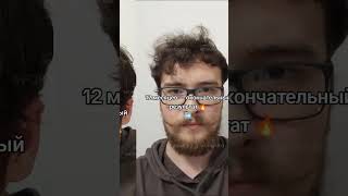 От облысения к естественному результату | 4500 графтов FUE метод результат