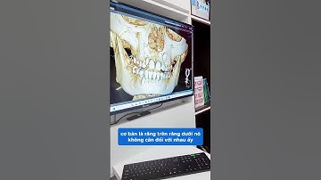Mọc Răng Có Ảnh Hưởng Đến Khuôn Mặt Không? Sự Thật Khiến Bạn Bất Ngờ! | Bác sĩ Cường