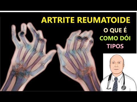 Vídeo: Aspectos Da Artrite Precoce. O Que Determina A Evolução Da Artrite Indiferenciada Precoce E Da Artrite Reumatóide? Uma Atualização Do Norfolk Arthritis Register