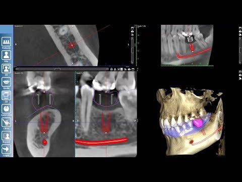 Implant Planning in Planmeca Romexis