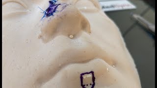 Local flaps on the face: The Rhomboid flap