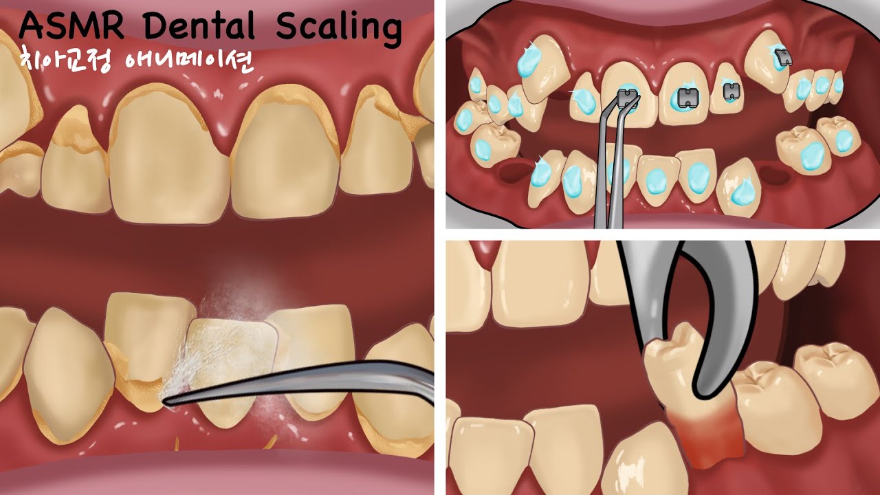 ASMR Satisfying braces animation Tartar Removal Dental Scaling
