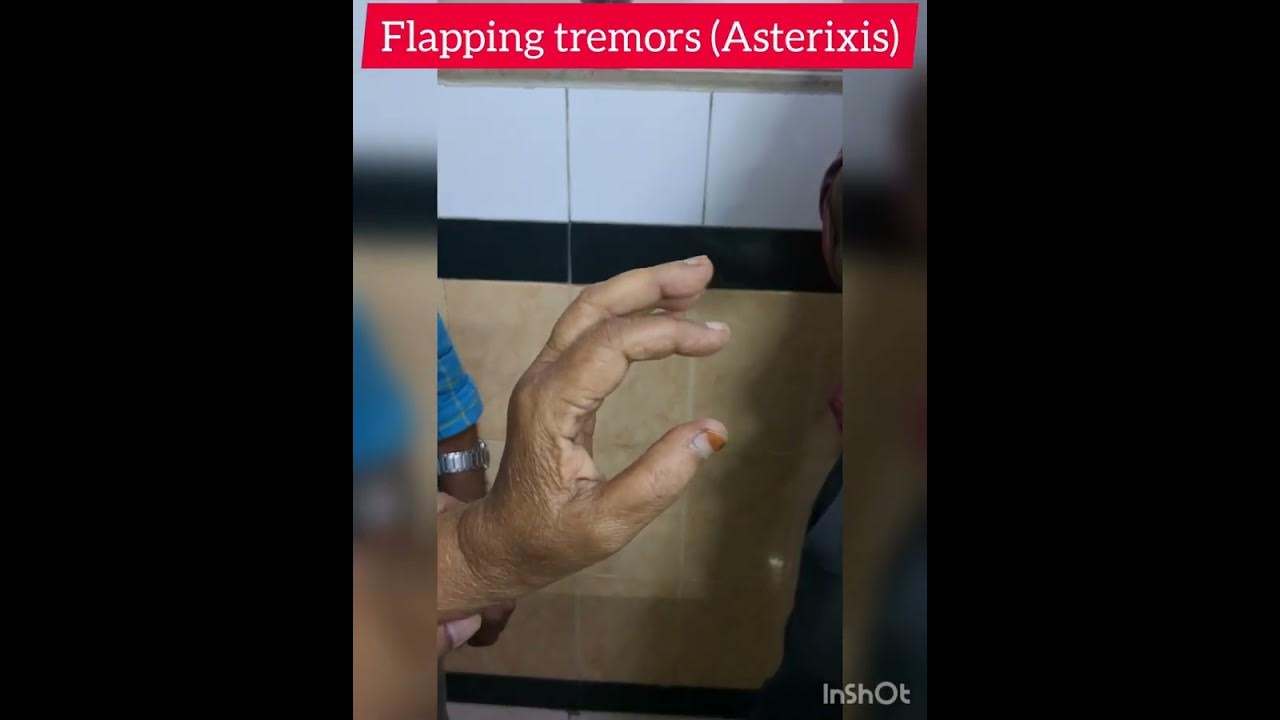 Flapping Tremors (Asterixis) In hands and legsDr.KamaleshTN_MediCal
