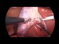 Cholecystectomy - L Hook Dissection