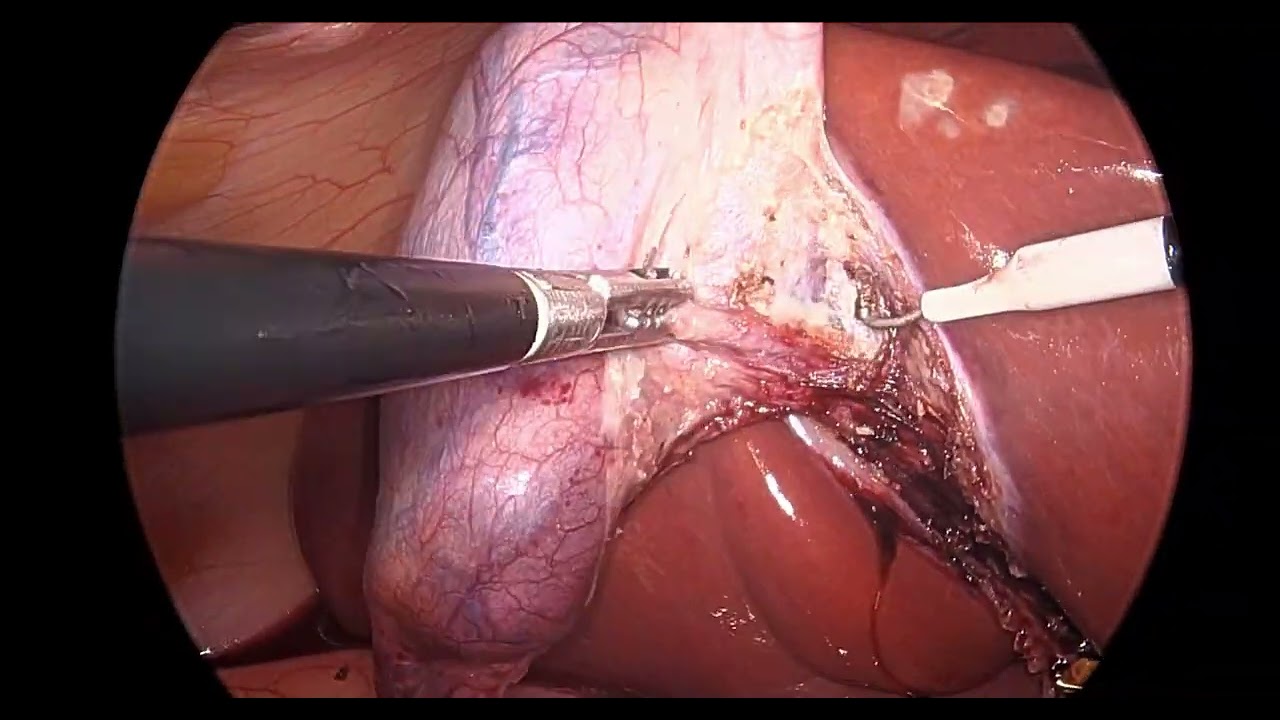 Cholecystectomy - L Hook Dissection