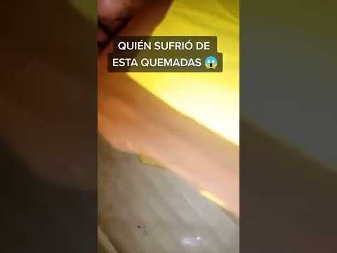 Video: Cómo tratar una quemadura de pegamento caliente