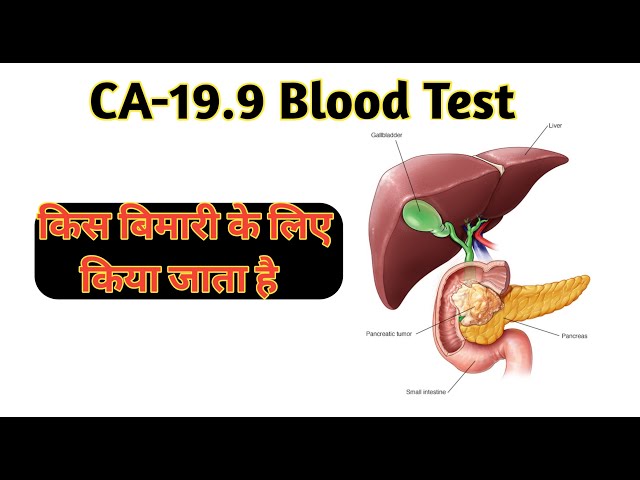 ca 19.9 blood test in hindi | ca 19.9 test class=