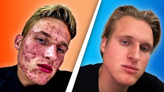 How I Cured My Acne Naturally (Only THIS worked!) screenshot 1
