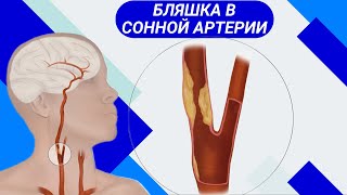 БЛЯШКА В СОННОЙ АРТЕРИИ: Чем опасна?