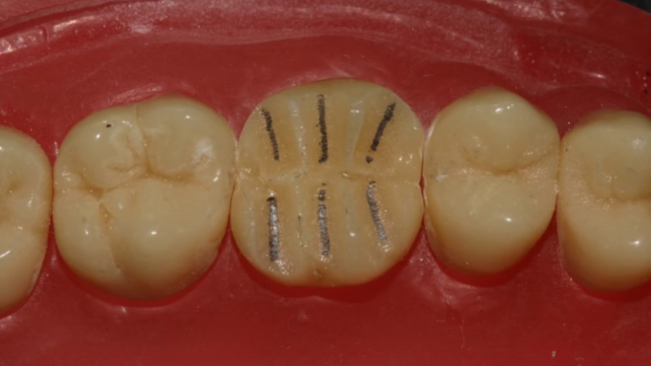 Passo a passo preparo para onlay cerâmica YouTube