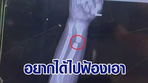 หญิงร้องหลาน 5 ขวบ แขนหักที่โรงเรียน ครูไม่ส่งรพ. บอกจะเยียวยา สุดท้ายกลับคำ ท้าฟ้อง