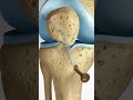 Anterior Curical Ligament repair surgery #arthroscopy #arthroplasty #acltear #ligamentsurgery