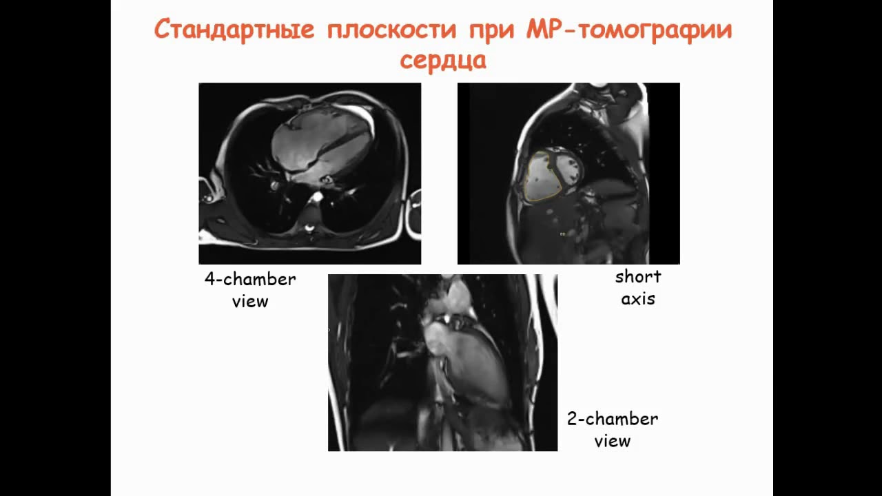 Рыжков А.В. «Возможности МРТ в диагностике легочной гипертензии»