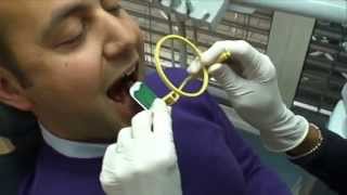 Super Bite anterior movie (EN)