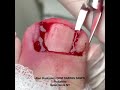 Removal of incurvated nail plate and hypertrophied nail folds