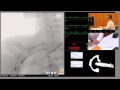 Catheterisation of Right Coronary Artery