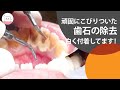 下の前歯には歯石がつきやすい!!歯石除去 Remove Sticky Dental Tartar