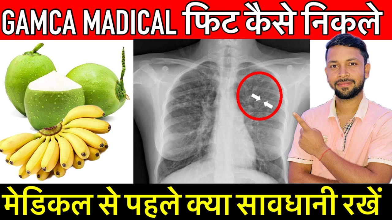 Gamca Medical Fit ॥Normal medical Fit मेडिकल फेल है।यह वीडियो पूरा ज़रूर देखें।gamca medical