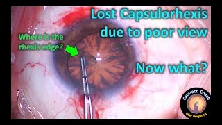 Lost Capsulorhexis during Cataract Surgery - here is how to fix this problem