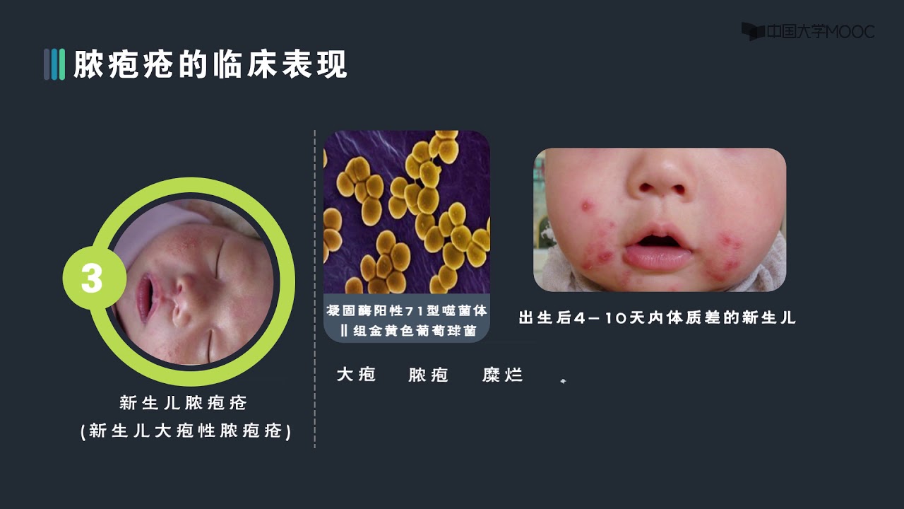 脓疱或脓肿