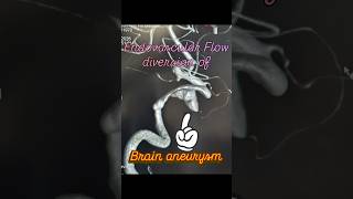 Brain aneurysm endovascular Flow diversion (stenting) #flowdiverter #brainaneurysm #brainstenting