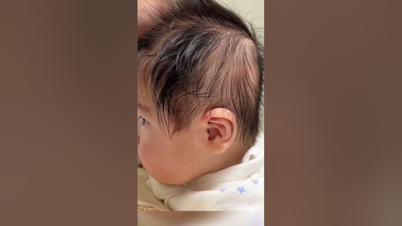 絶壁頭の赤ちゃんが たったの2ヶ月で変化が Youtube