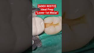 [ADEX RESTO] Ideal looking Mandi 1st Molar Prep #adex #restorative