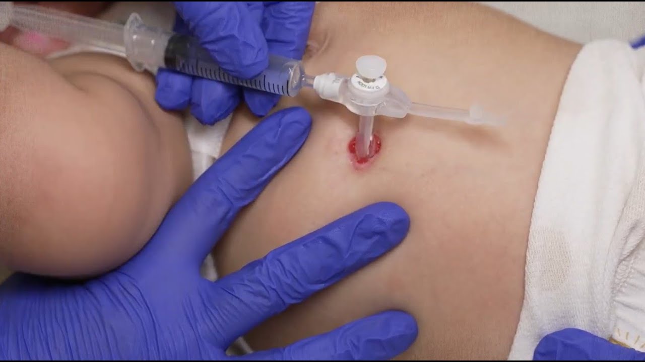 G-Tube - Changing the G-Tube - Stanford Medicine Children's Health